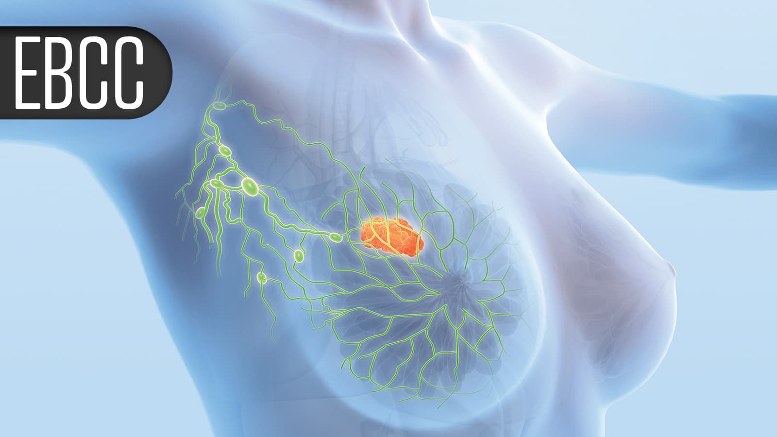 Low Breast Cancer Recurrence Rate With Radiotherapy Tailored to Nodal Response
