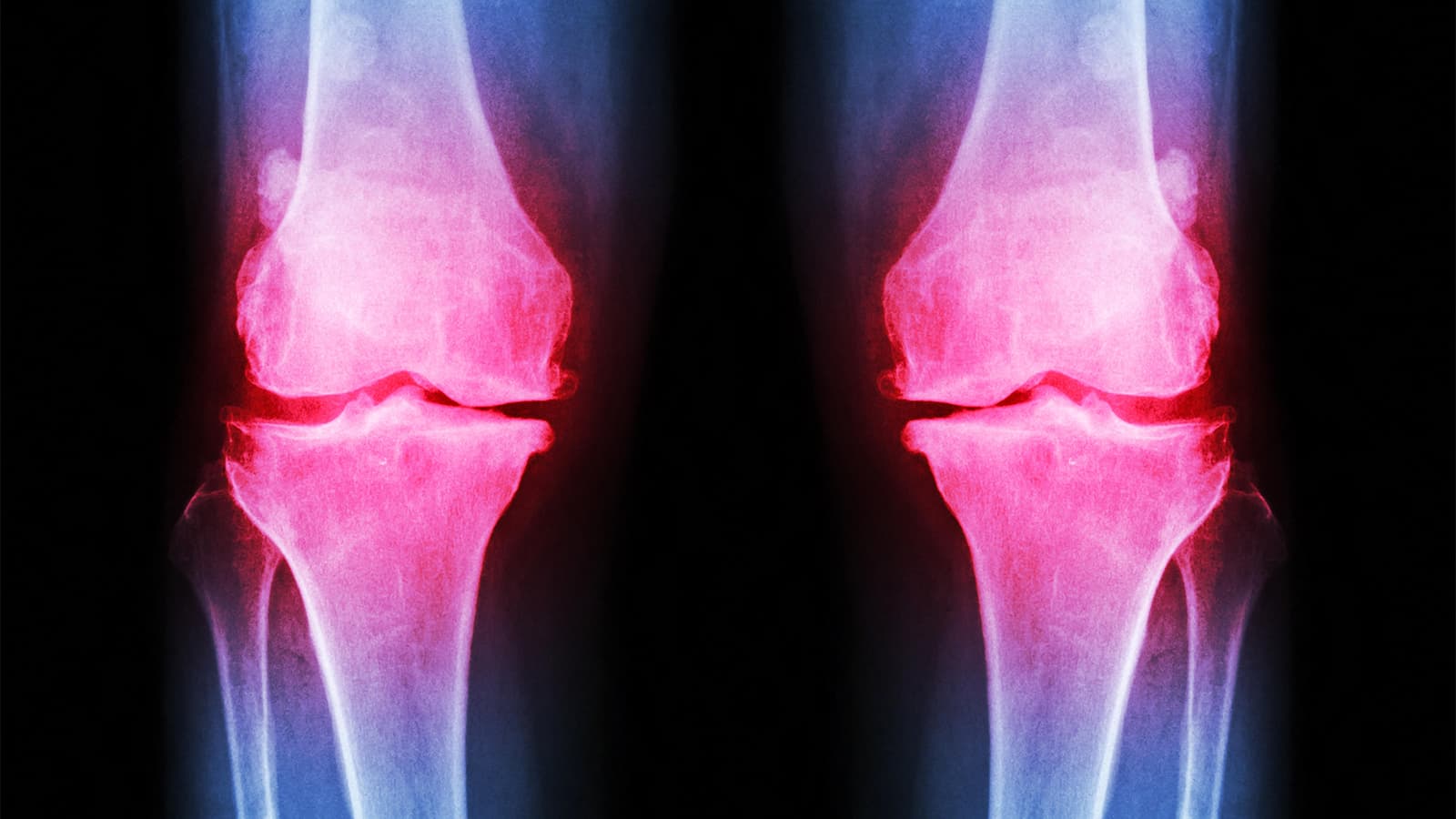 Trial Breathes New Life Into Neurotrophins as Target in Osteoarthritis