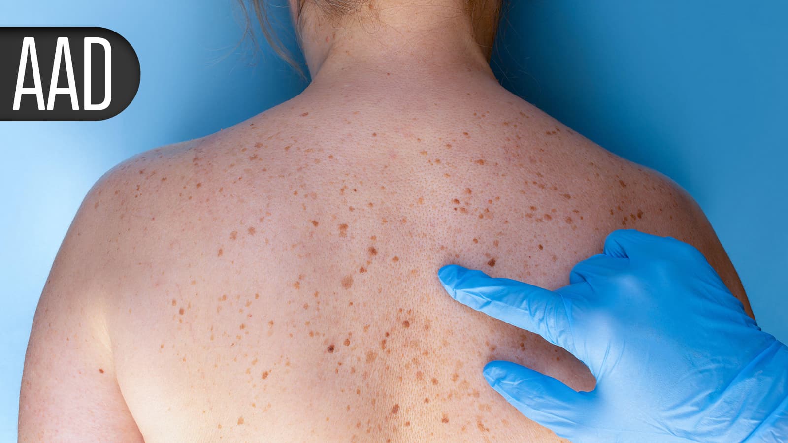 GLP-1 Drugs Pick Up Another Win, This Time in Psoriatic Arthritis