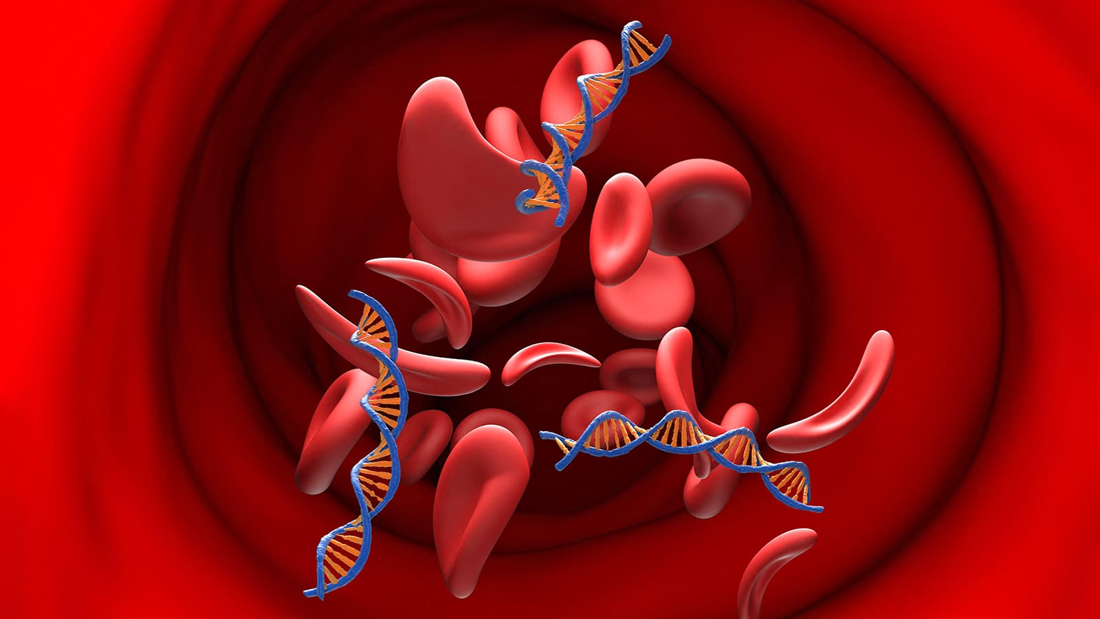 Base-Editing Gene Therapy Shows Promise in Sickle Cell Disease