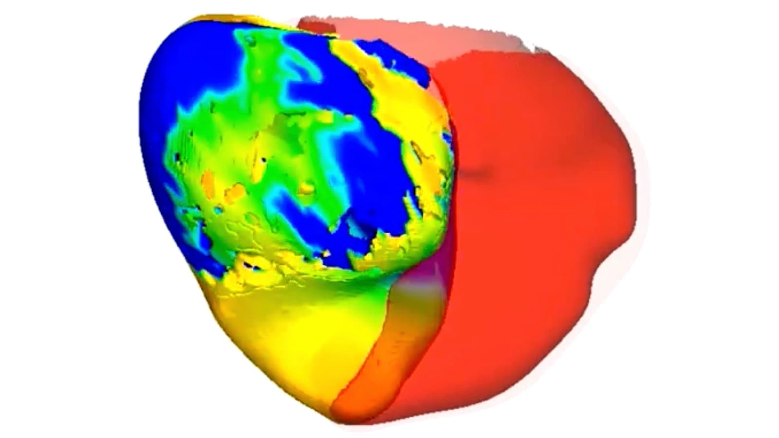 To Fix a Patient's Irregular Heartbeat, Doctors First Tested Its Digital 'Twin'