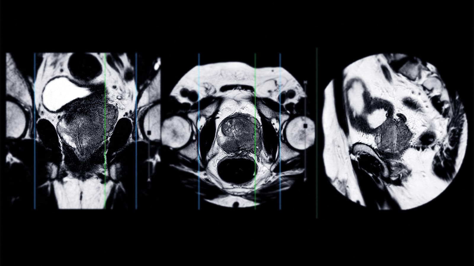 MRI Before Treatment Could Provide Prognostic Information in Prostate Cancer