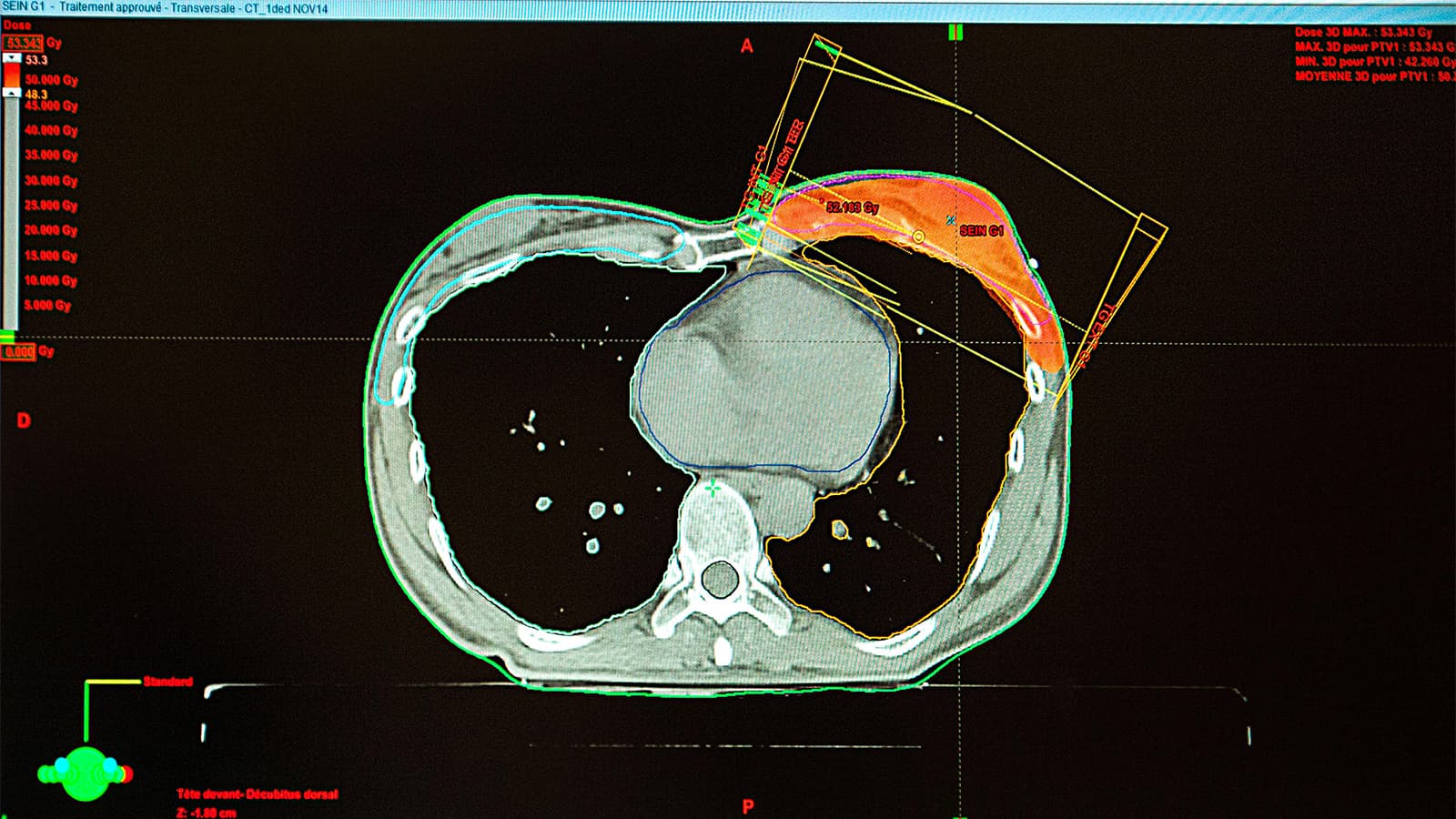 Modern Radiotherapy for Breast Cancer Likely Cut Heart Disease Risk