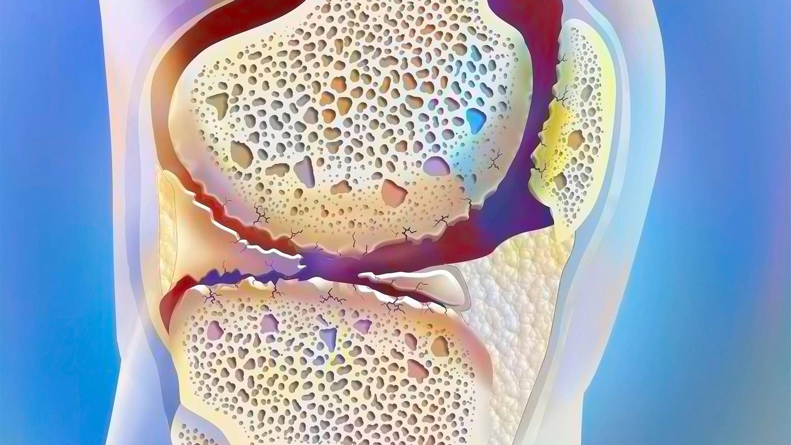 This Growth Factor May Play a Bigger Role in Osteoarthritis Than Previously Thought