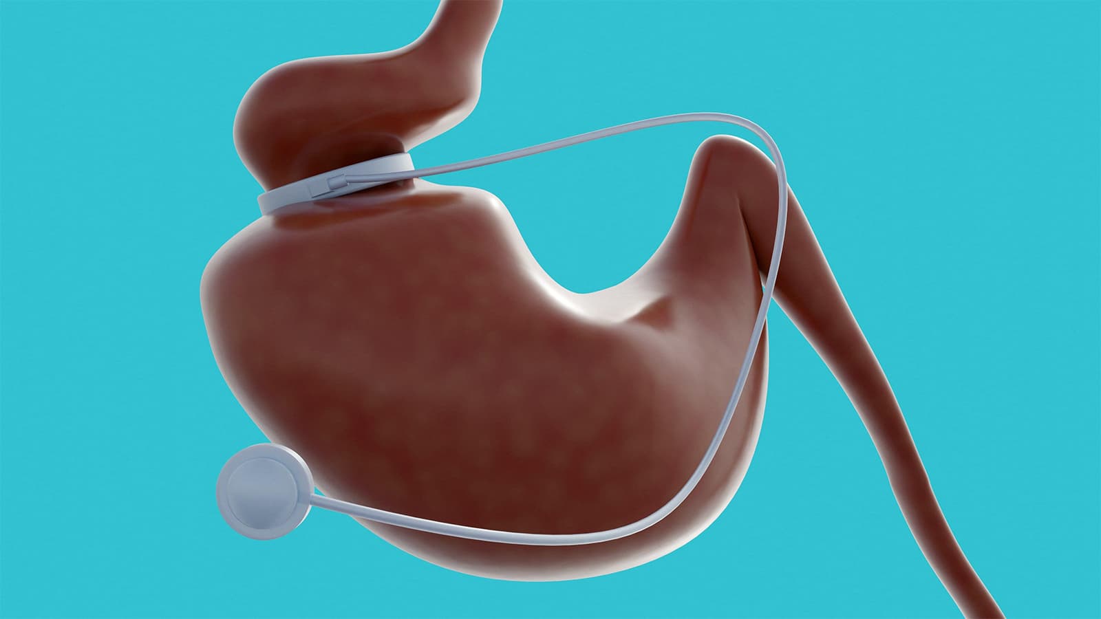 Call to Integrate Obesity Management With Surgery, GLP-1s Into Cancer Care