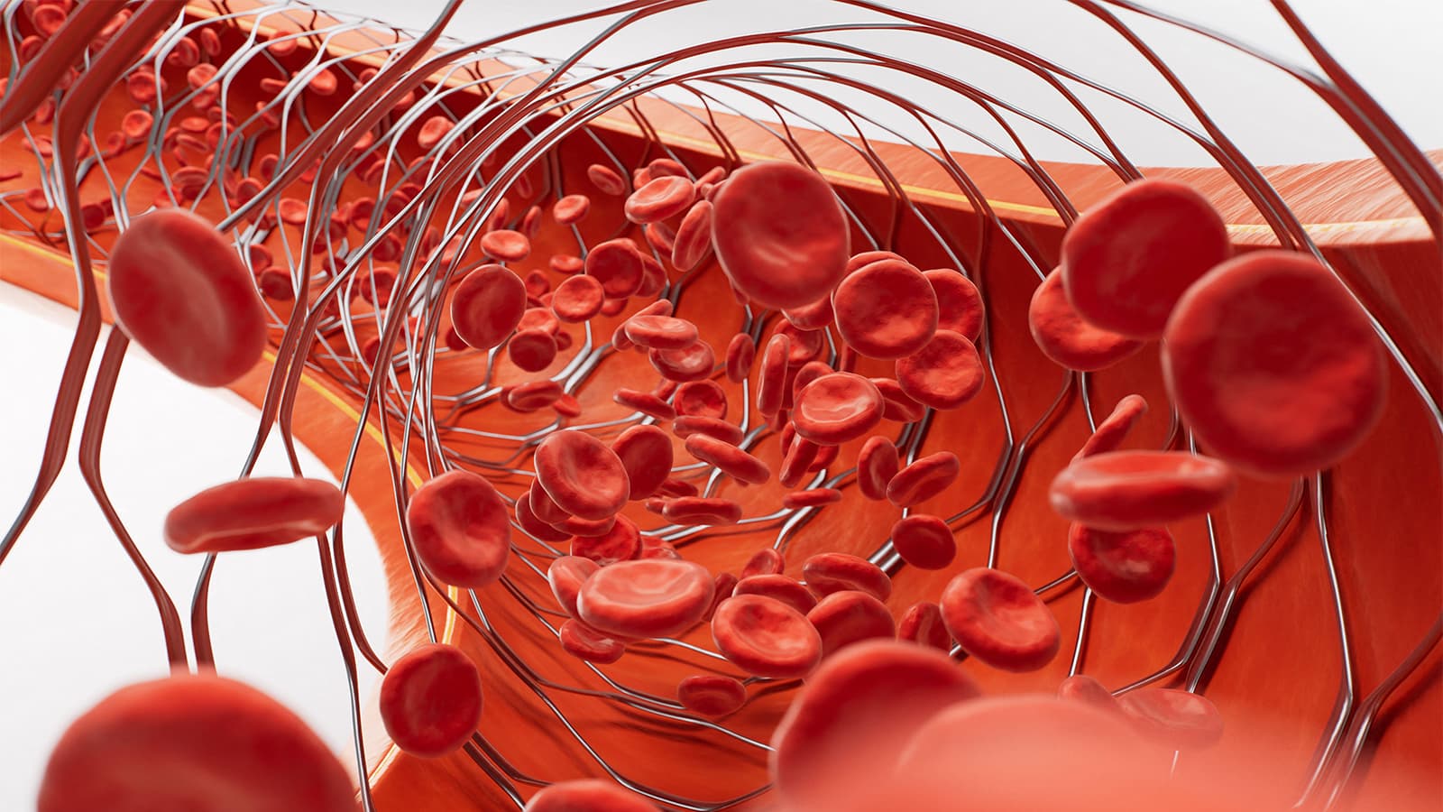 Stenting Eases Hard-to-Treat Venous Disease After Deep Vein Thrombosis