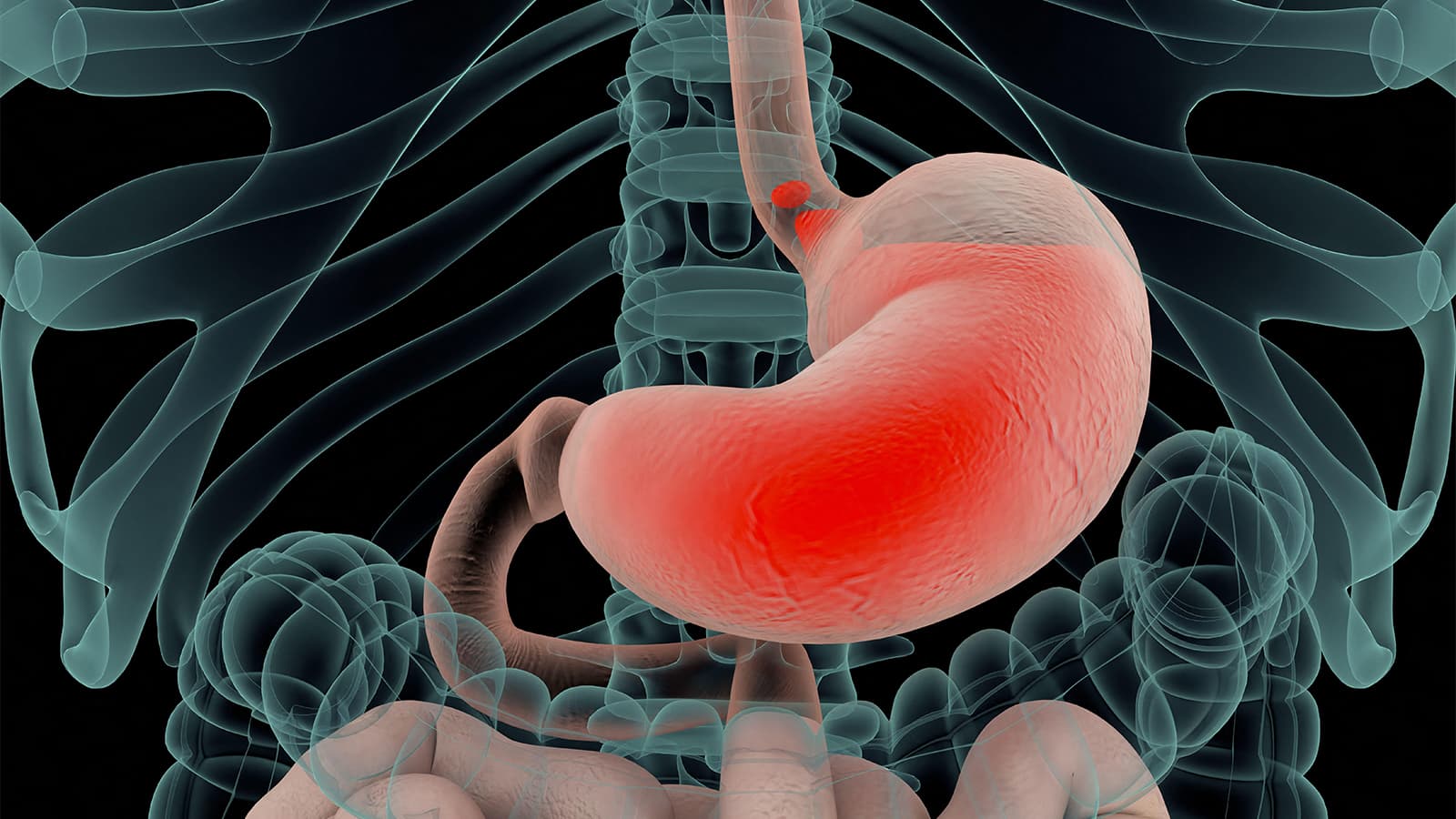 Strategy Reduces Inappropriate Proton Pump Inhibitor Use