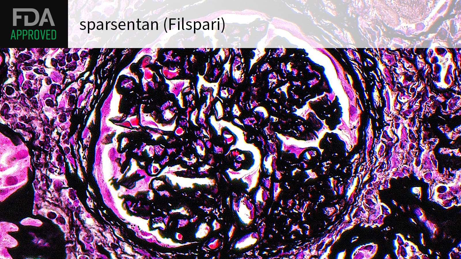 FDA Approves Sparsentan as First FSGS Treatment