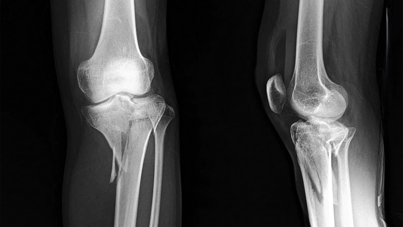 One Intrawound Antibiotic Wins for Surgical Infections After Tibial Fracture Surgery