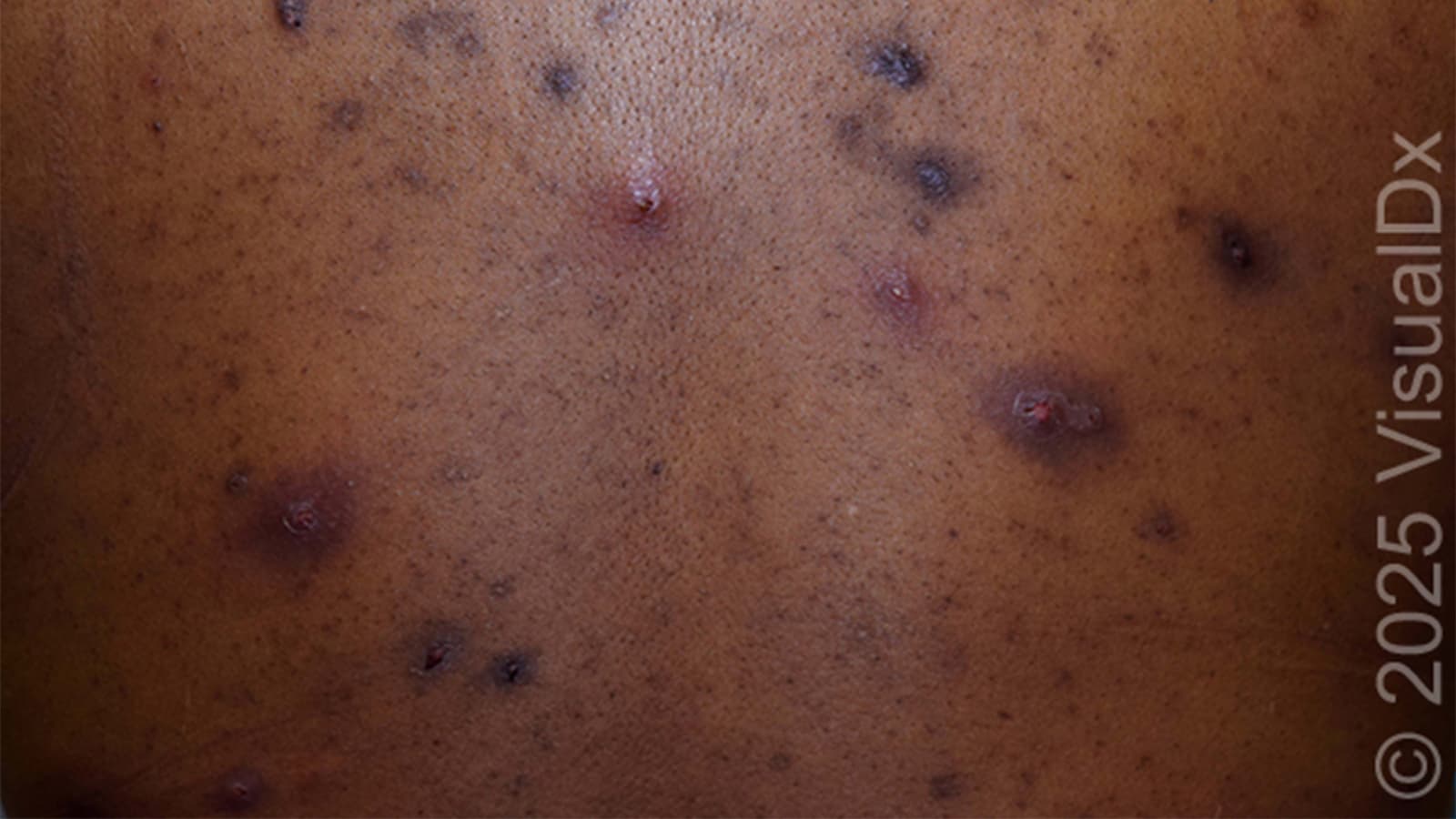 Make the Diagnosis: Is This Eruption Related to the Patient's Acne? His Ulcerative Colitis?