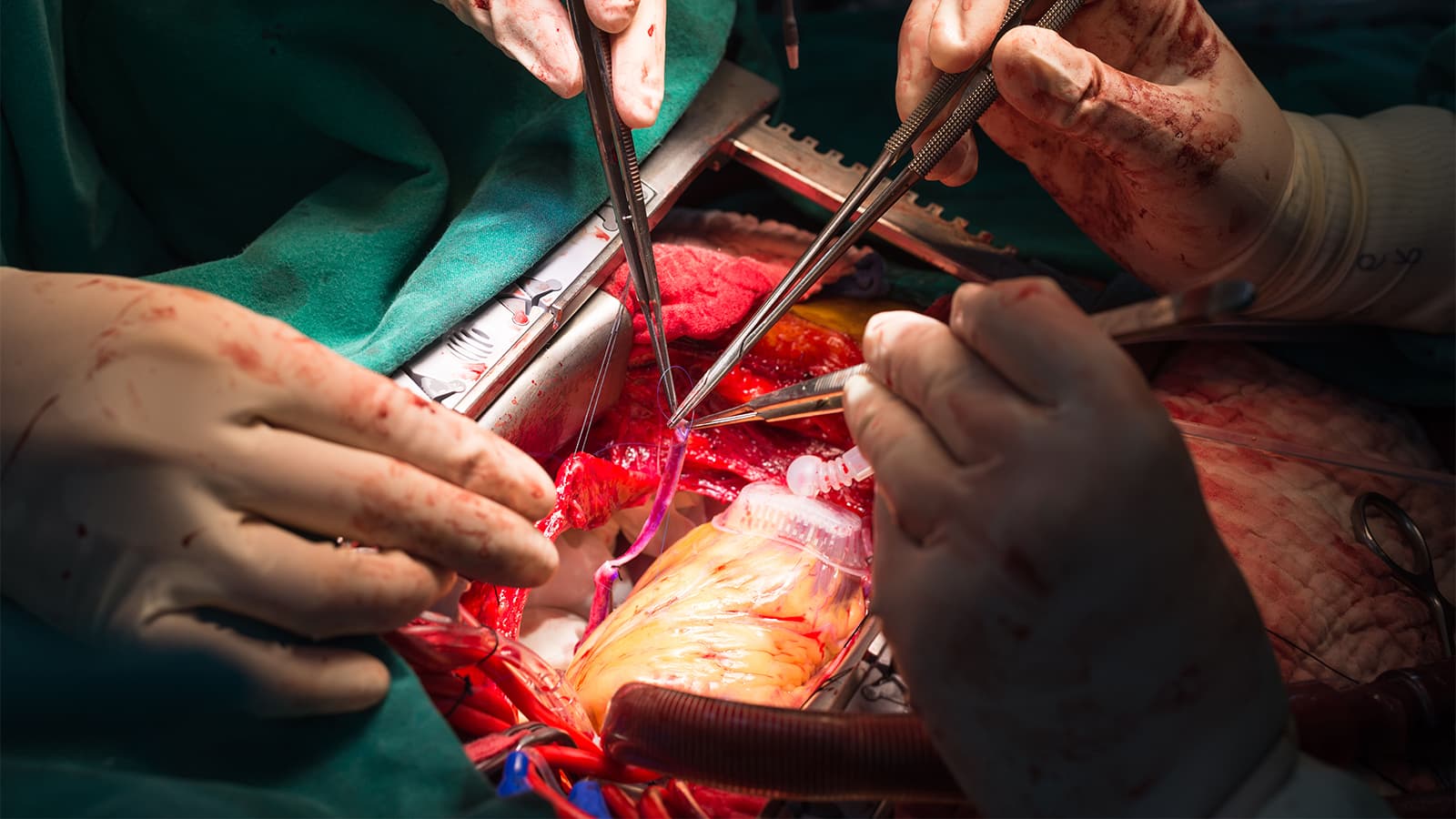 One Troponin Assay Would Suggest Whopping MI Incidence After Cardiac Surgery