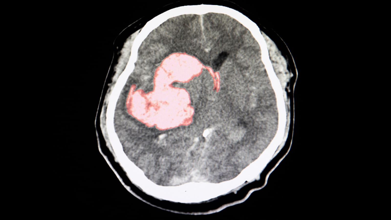 Triple Pill Gets Intracerebral Hemorrhage Survivors Closer to BP Goals
