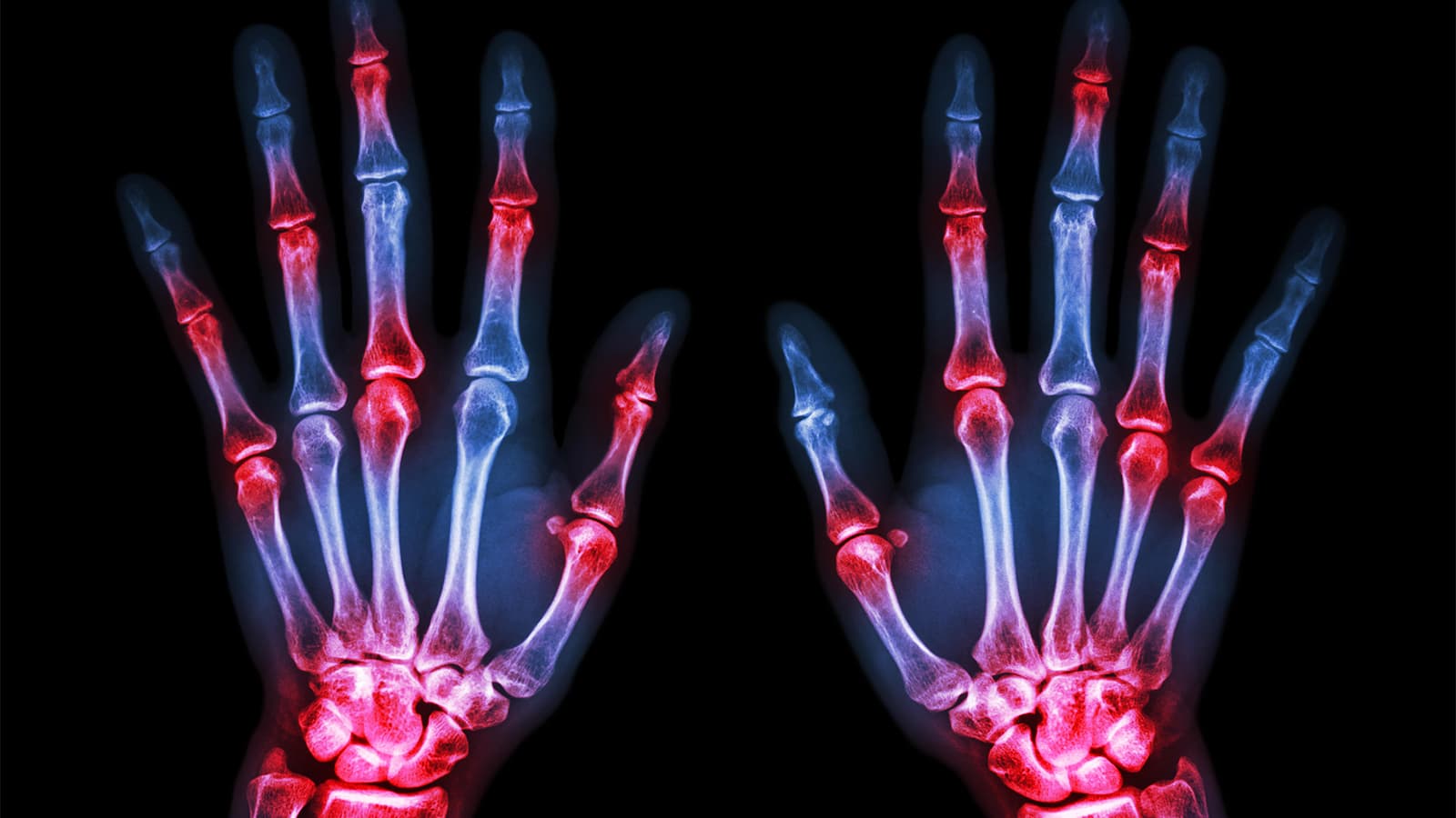 Machine Analyzes Joint X-Rays About as Well as Humans