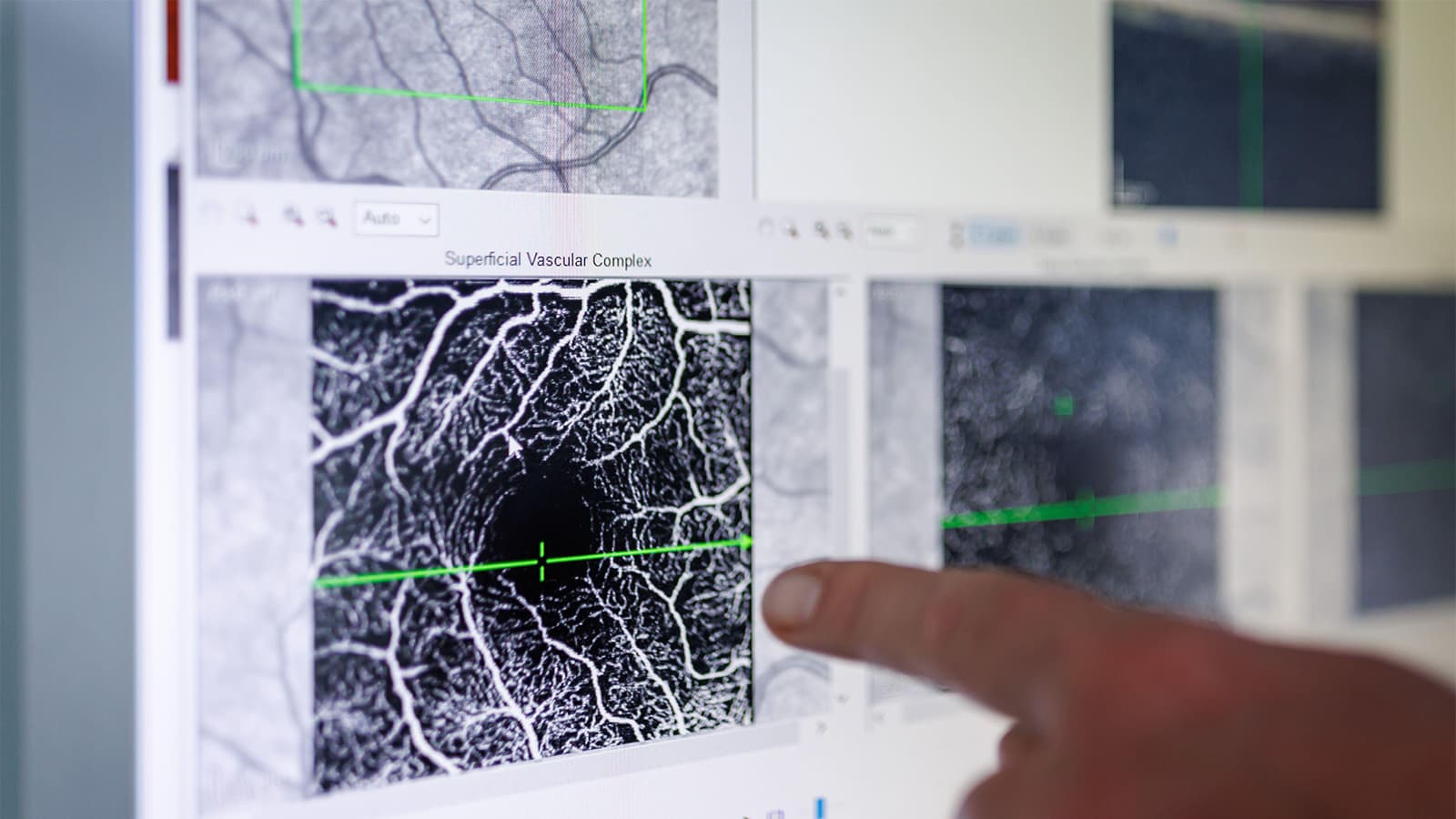 Imaging Finding for AMD Precursor Not as Accurate as Commonly Believed