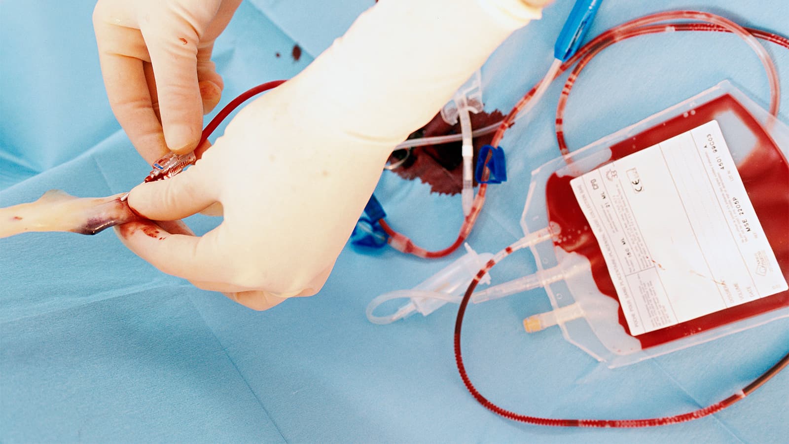 Pooled Cord Blood Transplants Achieve Near-Perfect Results in Early Trial