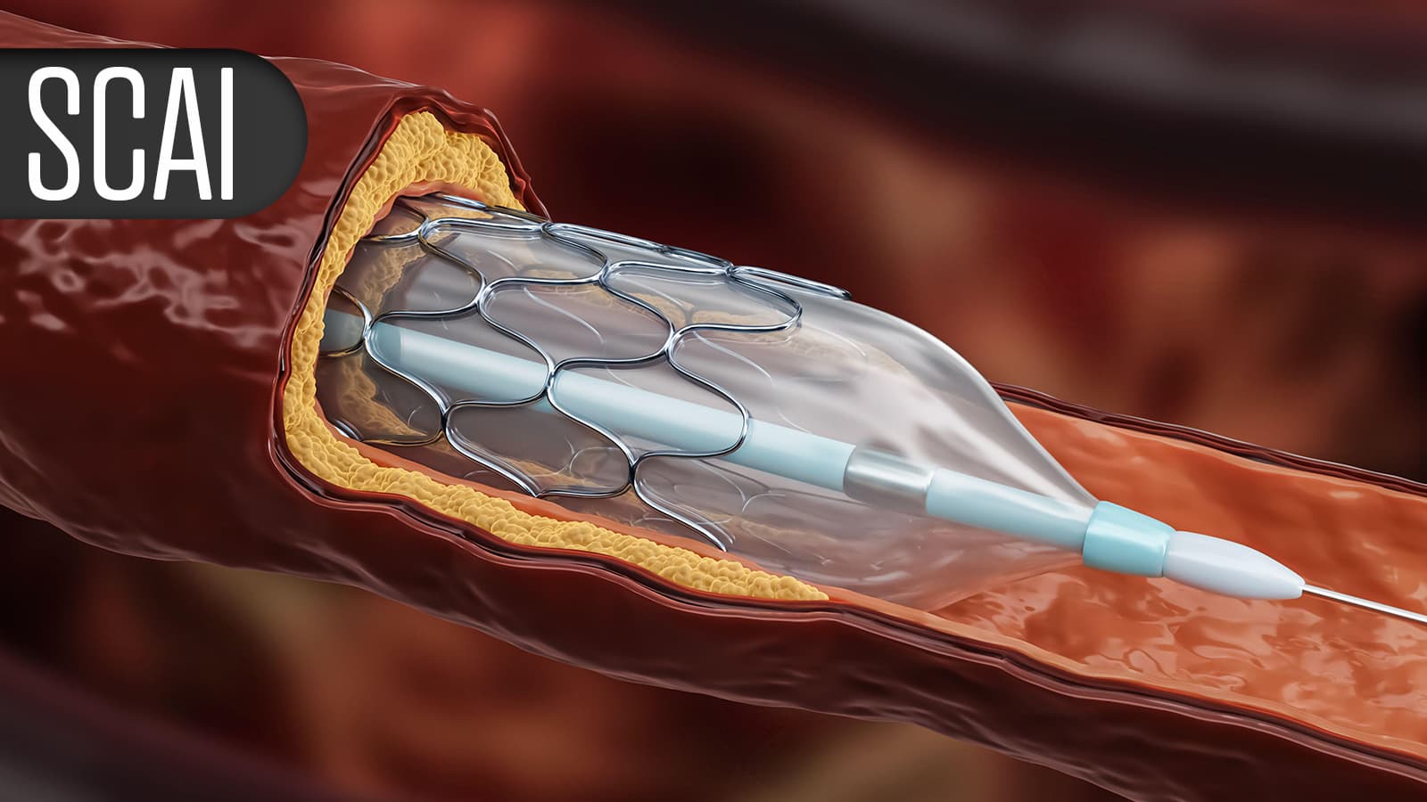 Growing Pains Observed With Radial Access in Peripheral Artery Intervention