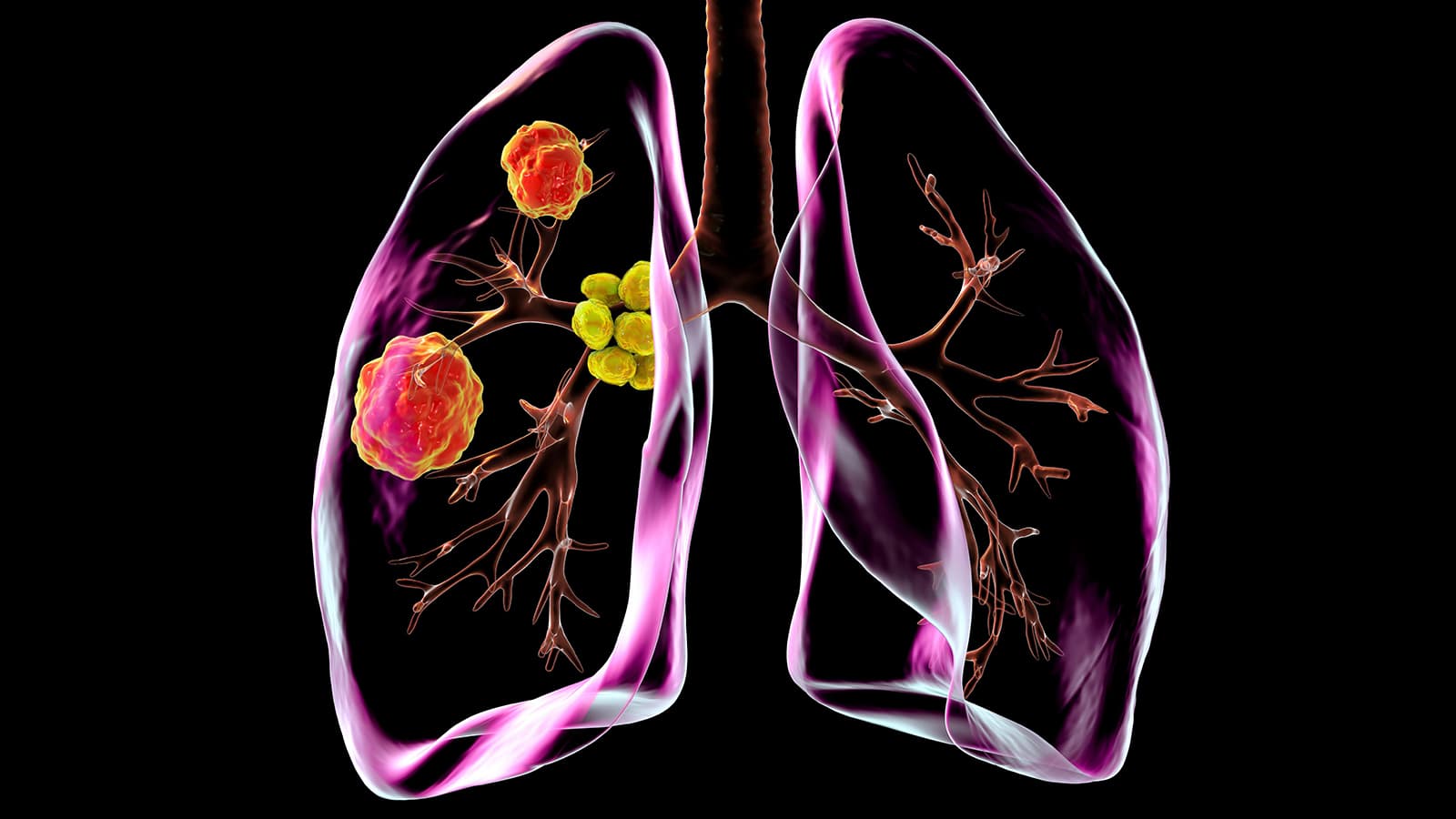 High Rate of Surgical Success in Complex NSCLC With Neoadjuvant Chemoimmunotherapy