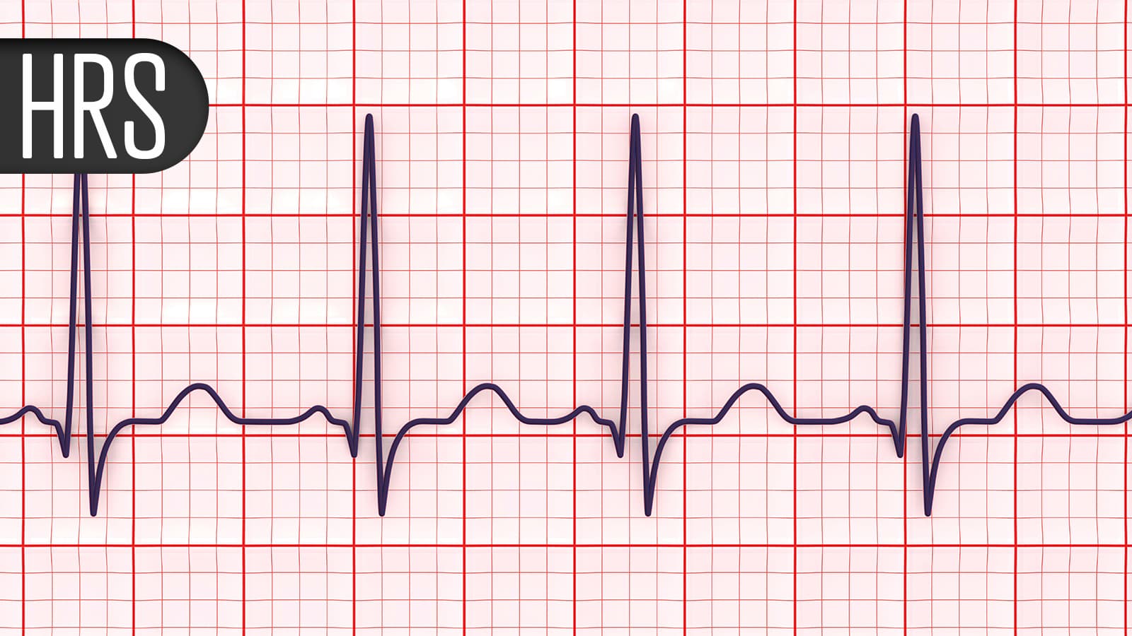 Risky Test Not Necessary for Subcutaneous ICD Implants