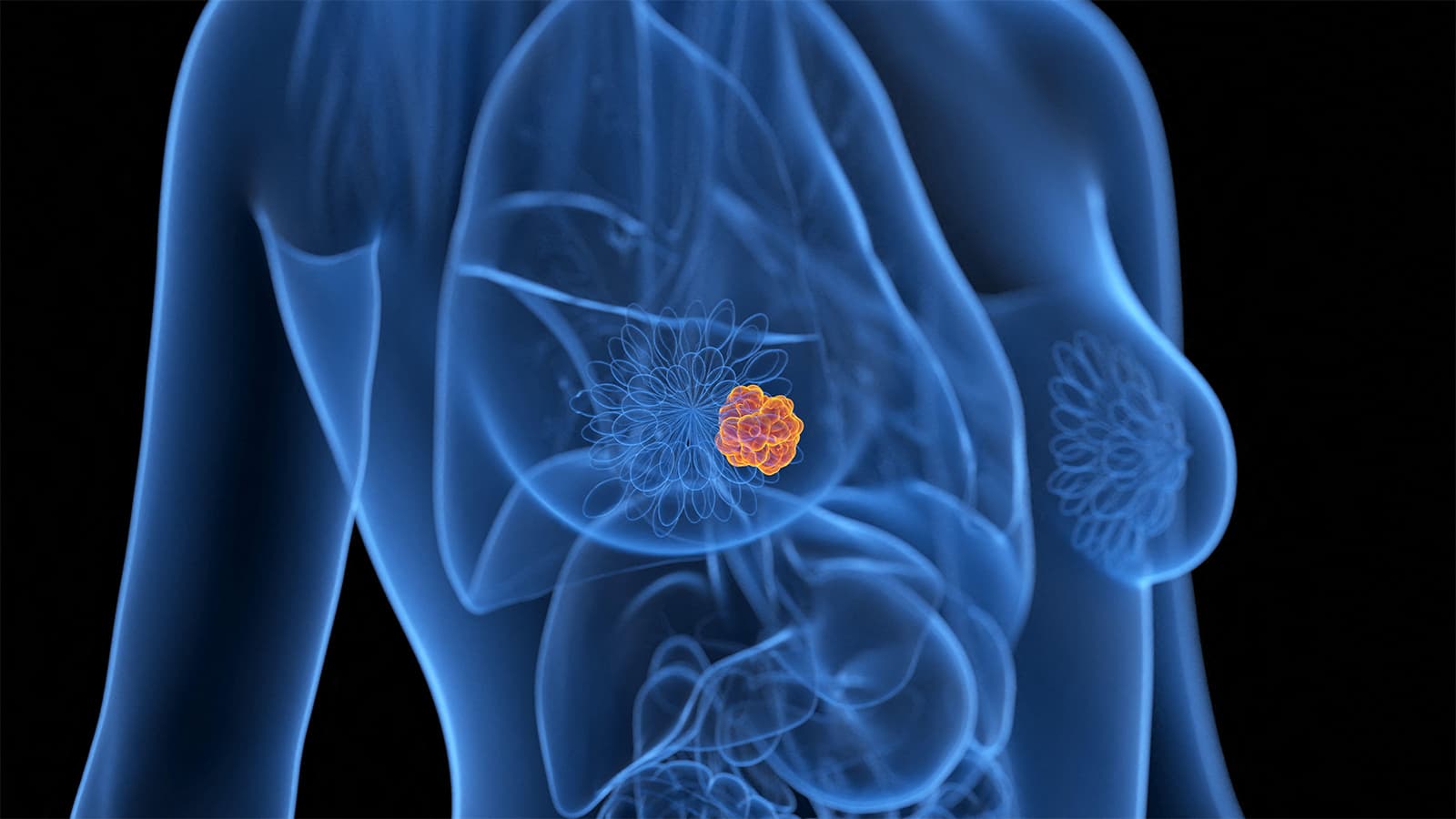 FDA Panel Gives Thumbs Down to Novel Strategy for Switching Breast Cancer Therapy