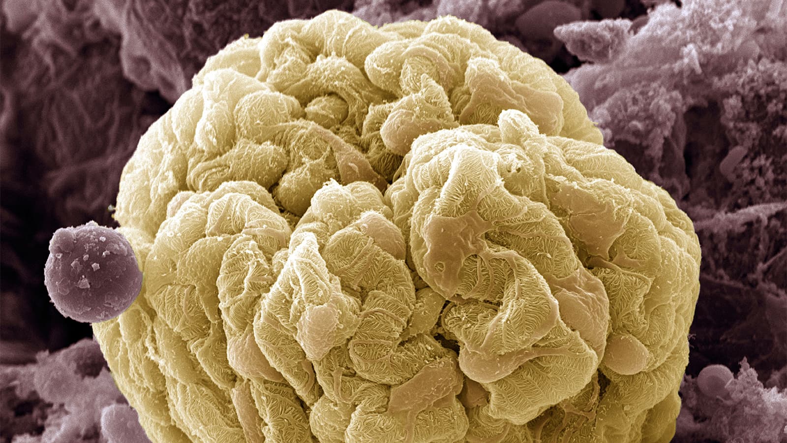 Differentiating the Trio of Focal Segmental Glomerulosclerosis Causes