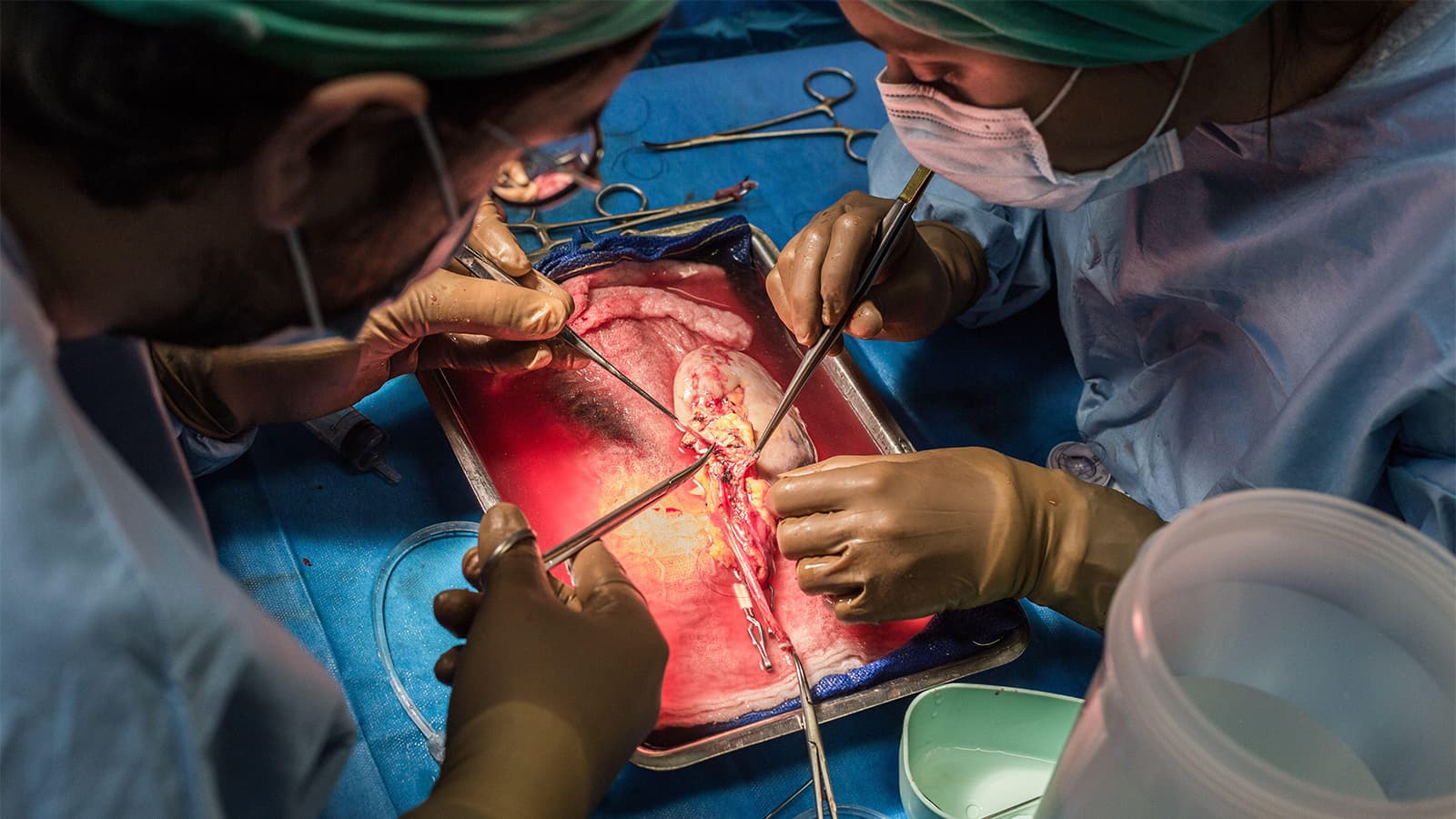 Risk of Focal Segmental Glomerulosclerosis Recurrence After Kidney Transplant