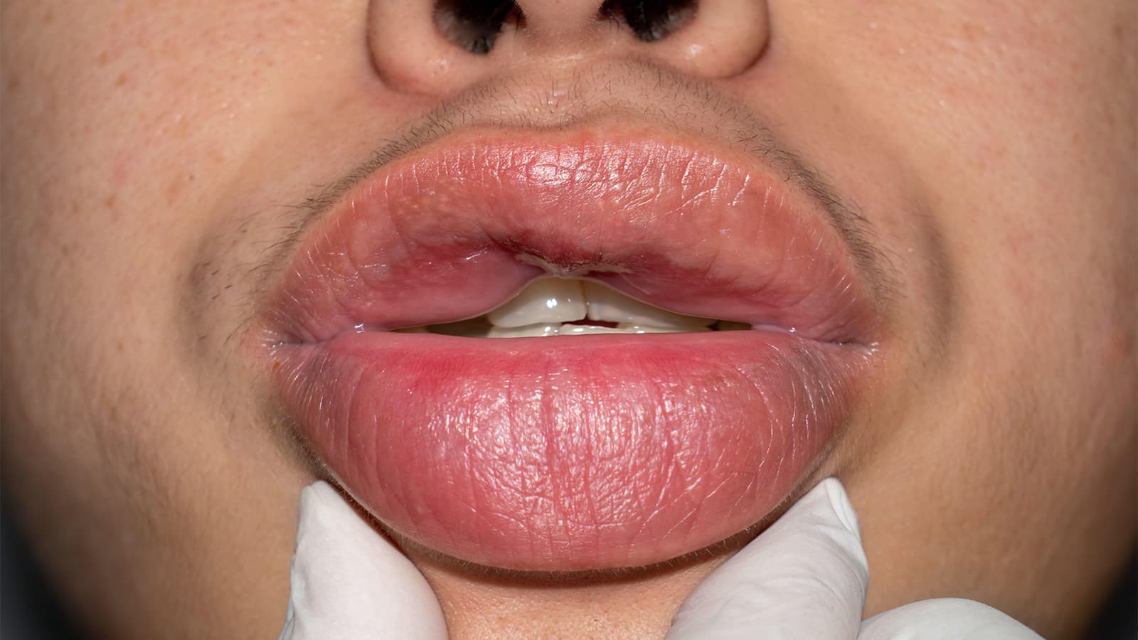 Hereditary Angioedema: Epidemiology and Prevalence