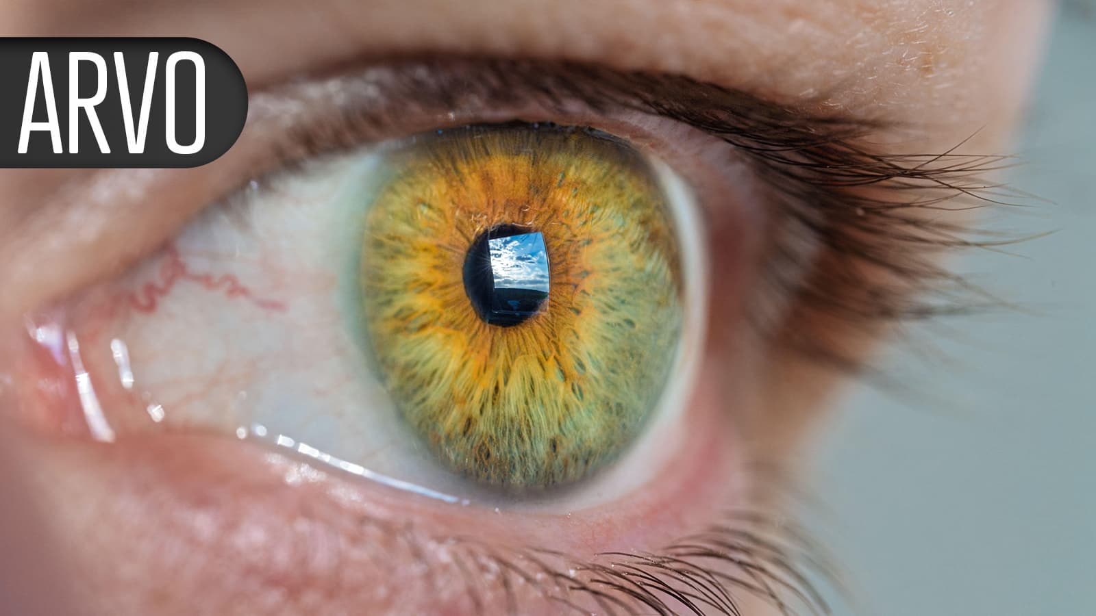 Vision-Threatening Forms of Diabetic Retinal Disease Have Plummeted