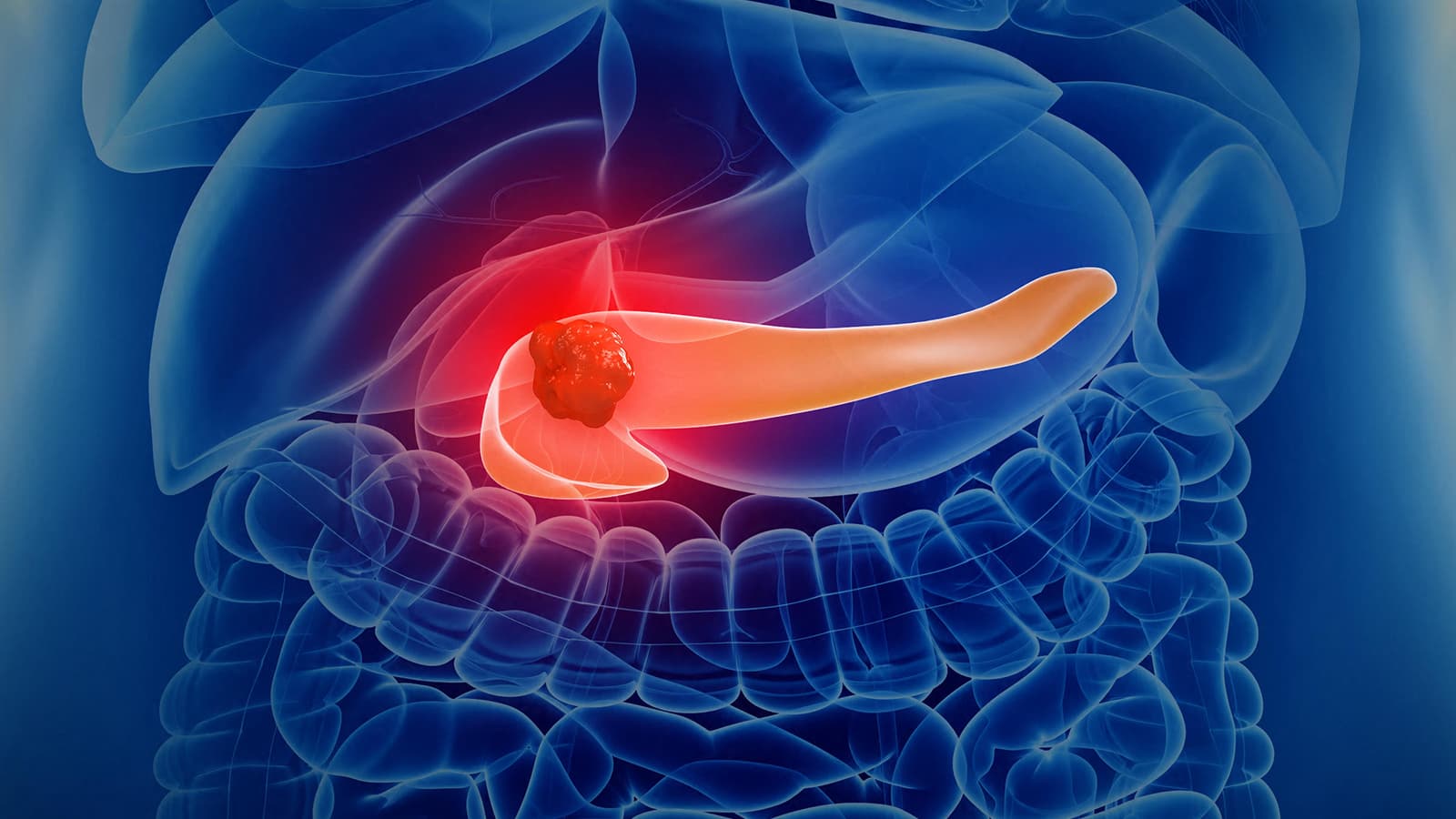 Safety Data on the Novel Pancreatic Cancer Drug Available by Early Access