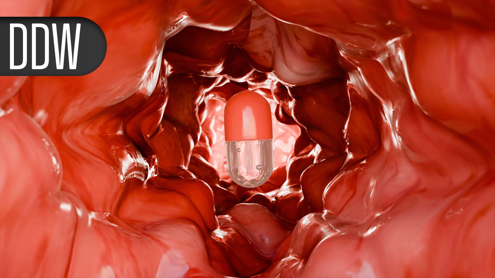 5-Year Data Support Top-Down Therapy in Crohn's Disease