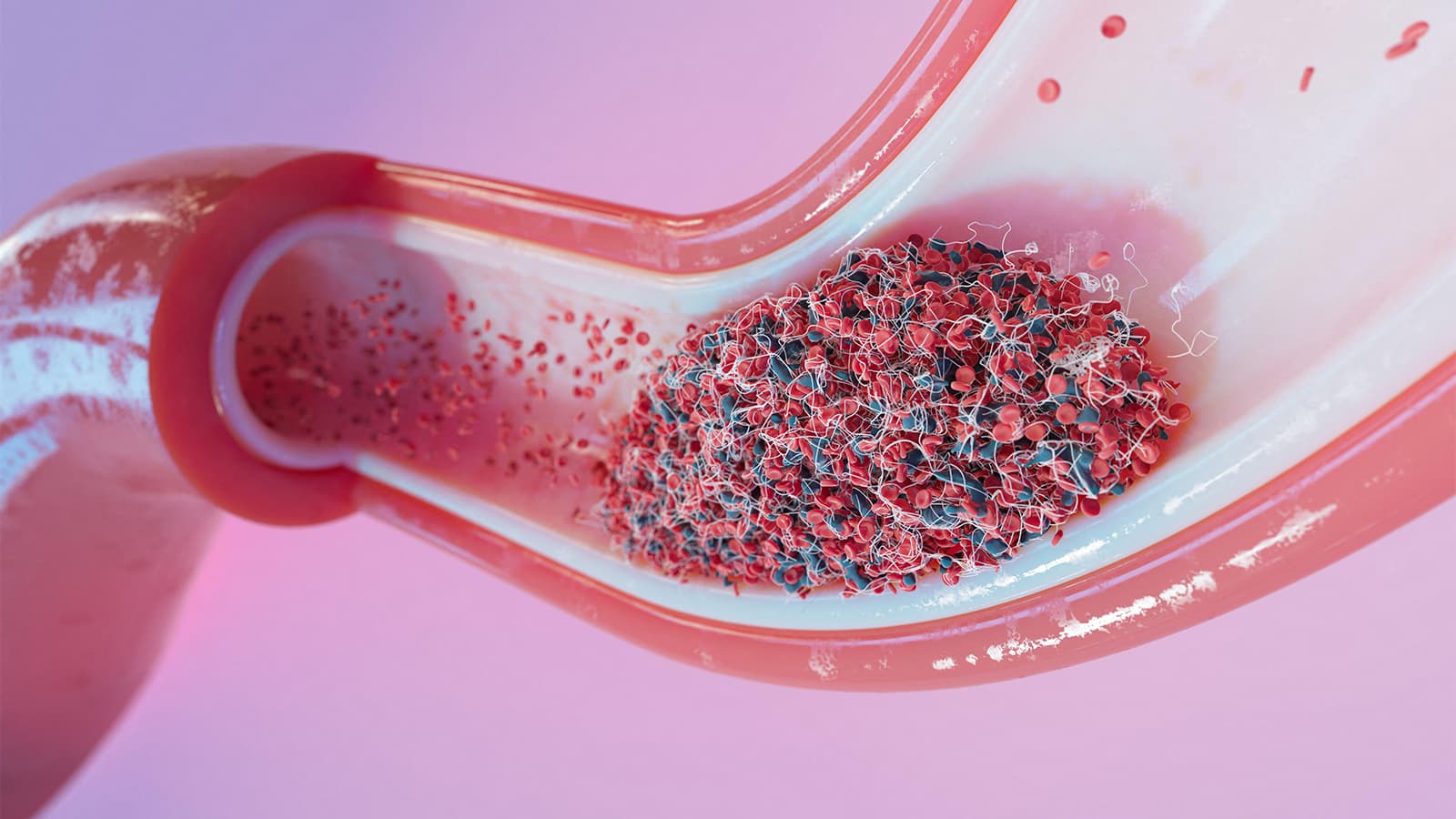 Tirofiban After Lytic Helps Select Acute Ischemic Stroke Patients