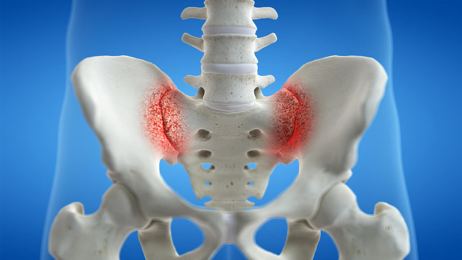 Sacroiliac Bone Edema: Overrated as Diagnostic Marker of Spondyloarthritis?