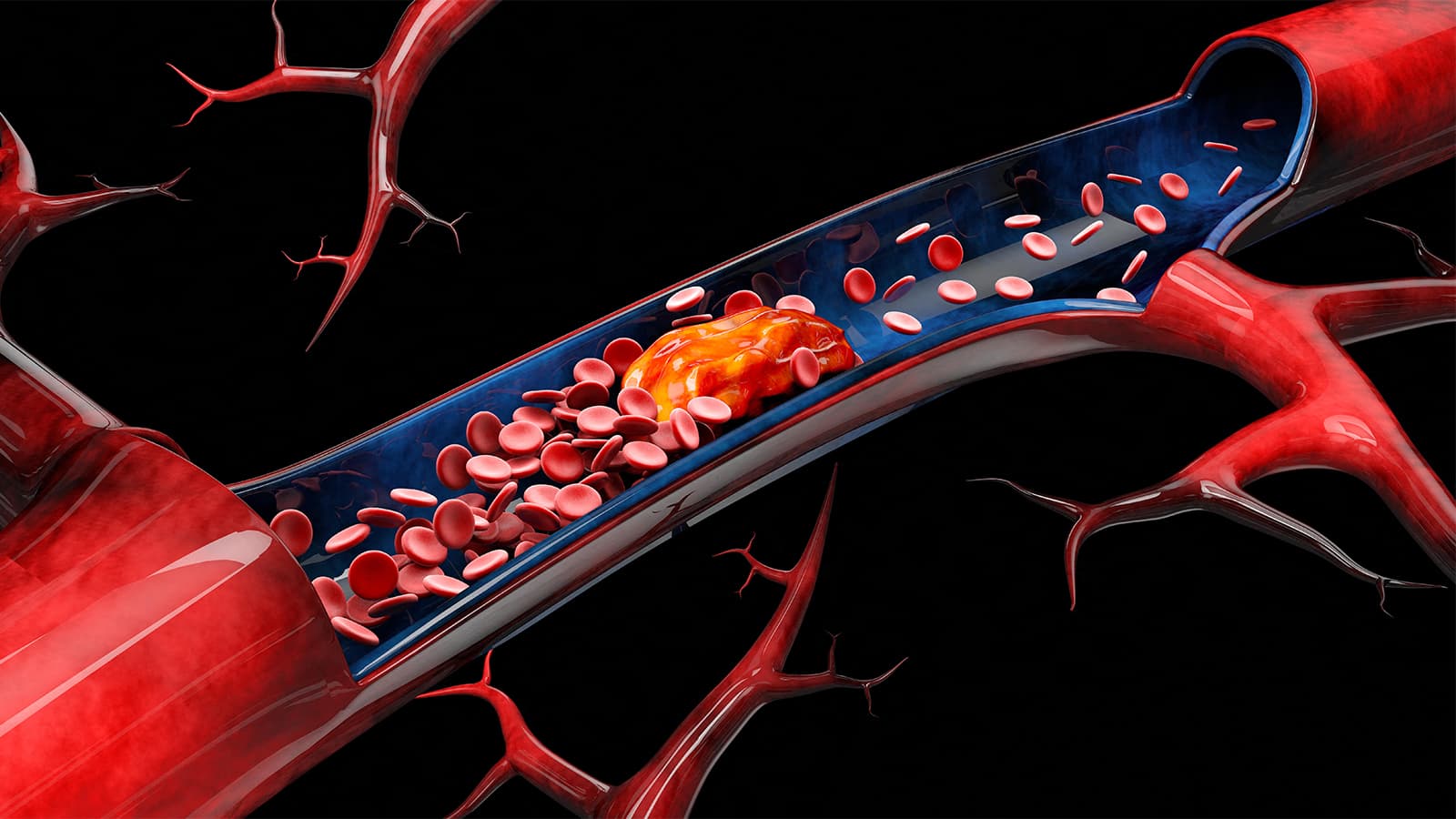 Endovascular Thrombectomy Boosts Outcomes in Medium-Vessel Ischemic Stroke