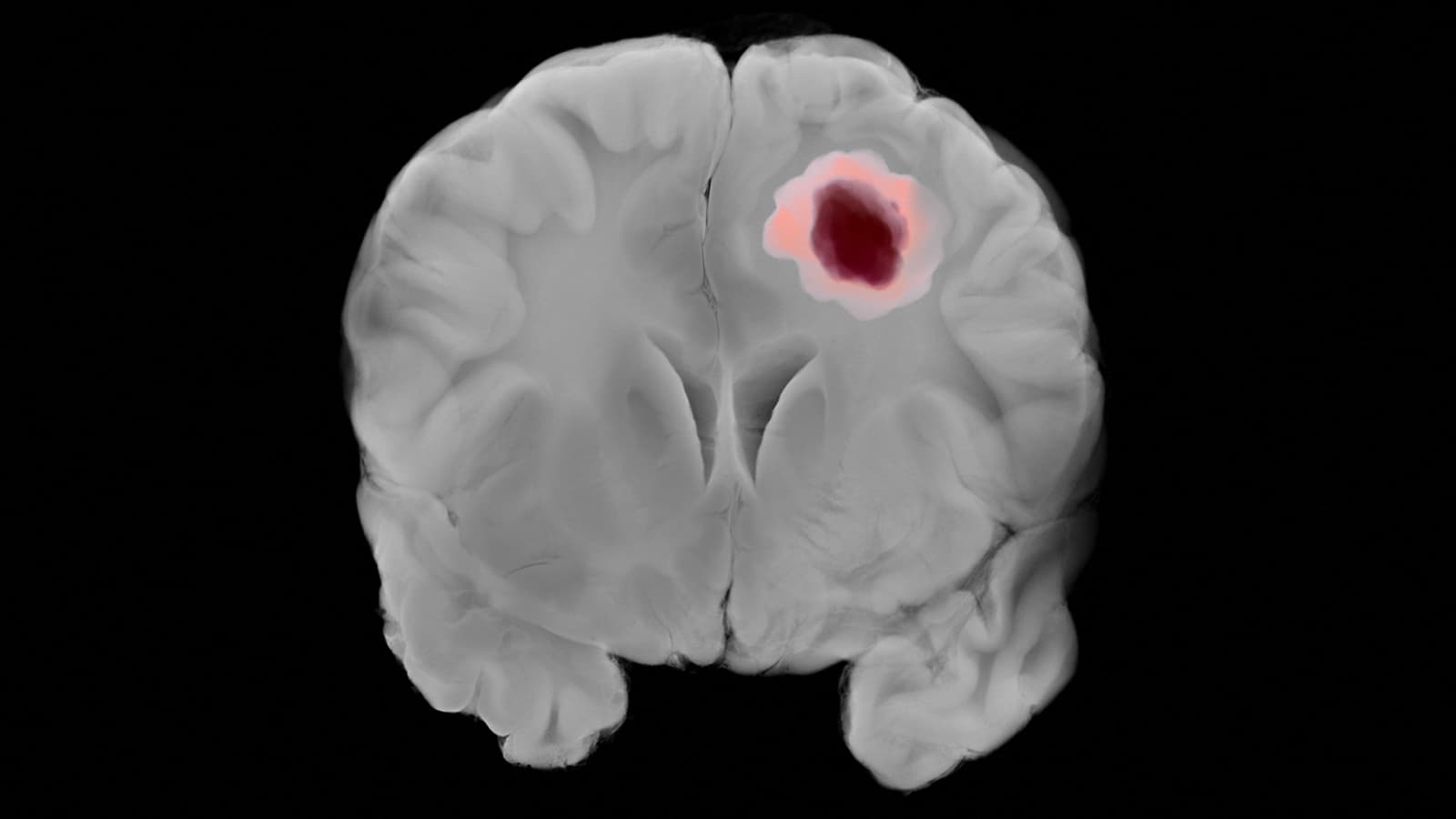 Personalized DNA Vaccine Shows Promise in Brain Cancer