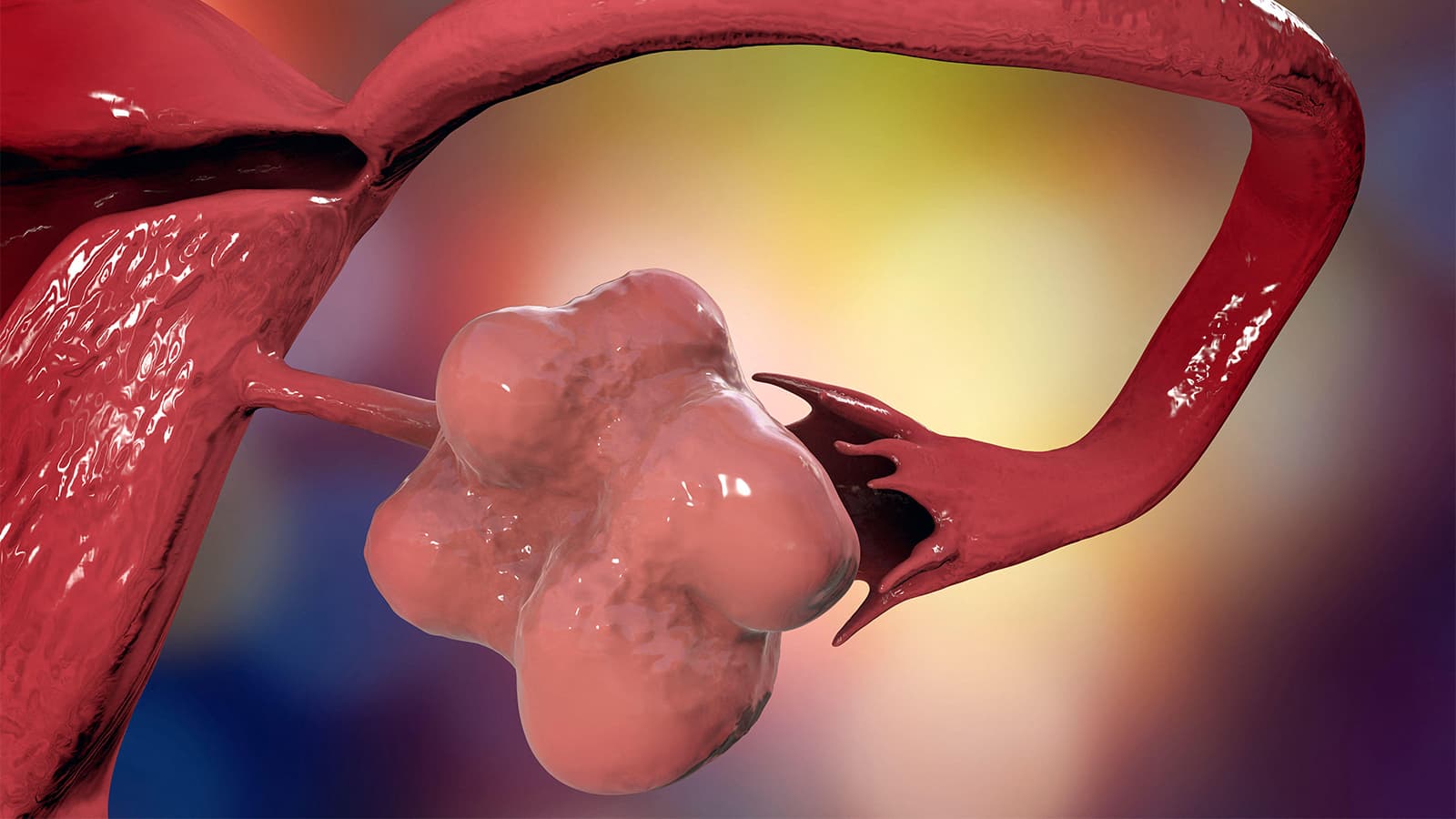 New Name for PCOS More Accurately Reflects Condition