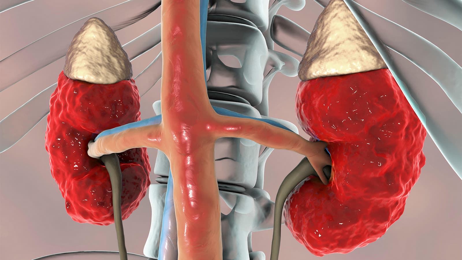 Trial Dims Prospects for Rivaroxaban's Cardiovascular Protection in Advanced CKD