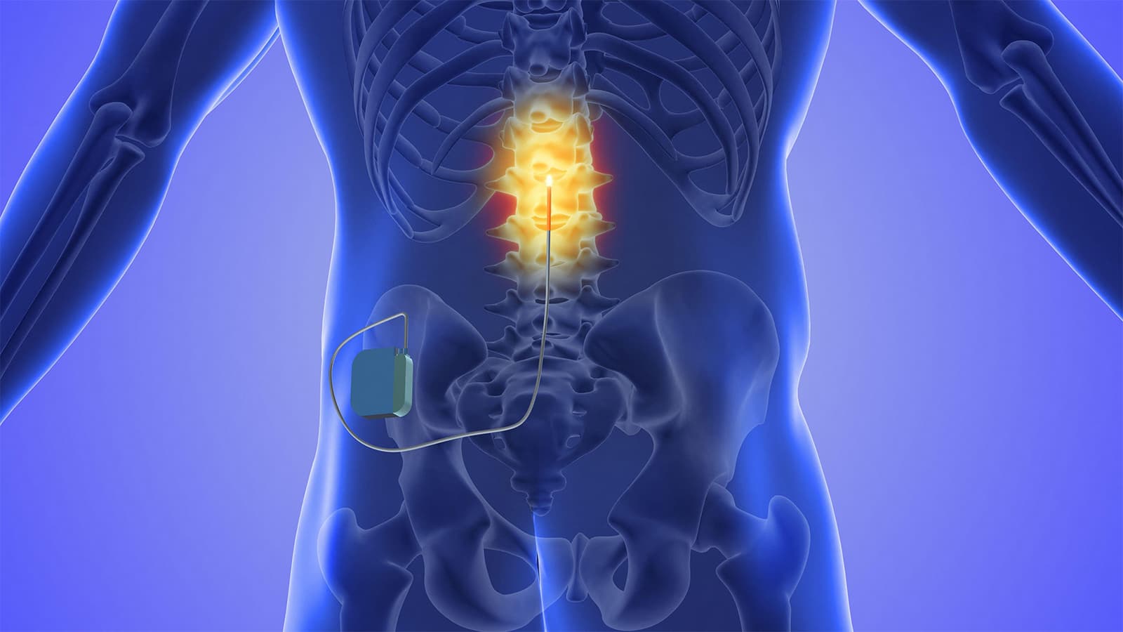 Spinal Cord Stimulation Restores Hand and Arm Mobility After Stroke