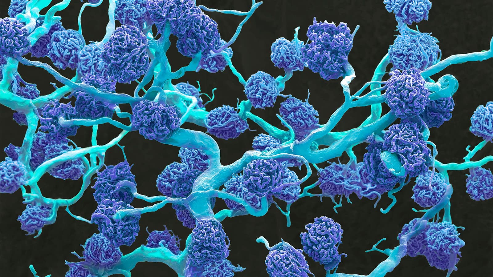 B-Cell Depleter Nabs Phase III Win in Autoimmune Kidney Disease