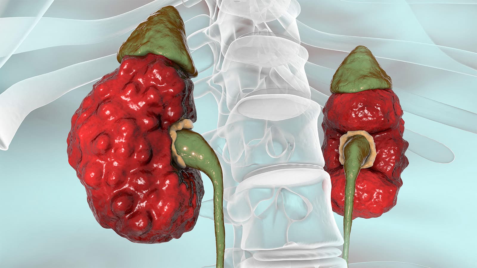 Finerenone Also Slows Kidney Decline in Diabetes-Free Patients