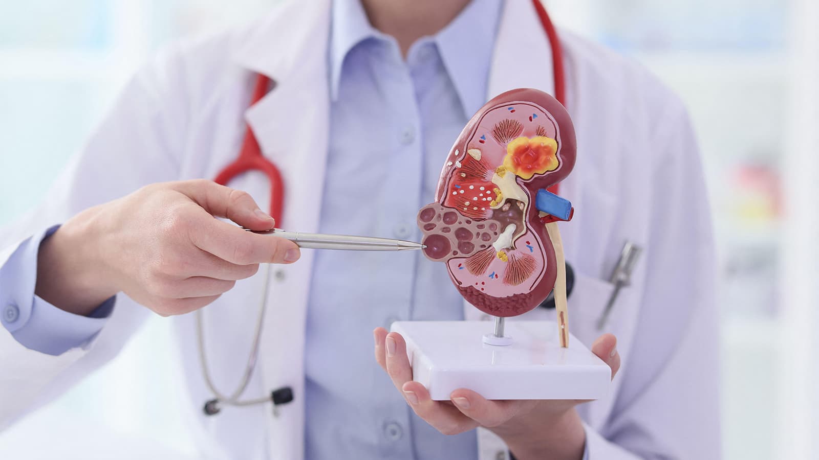AI-Triggered Nephrology Consult Fails to Prevent Acute Kidney Injury in Trial