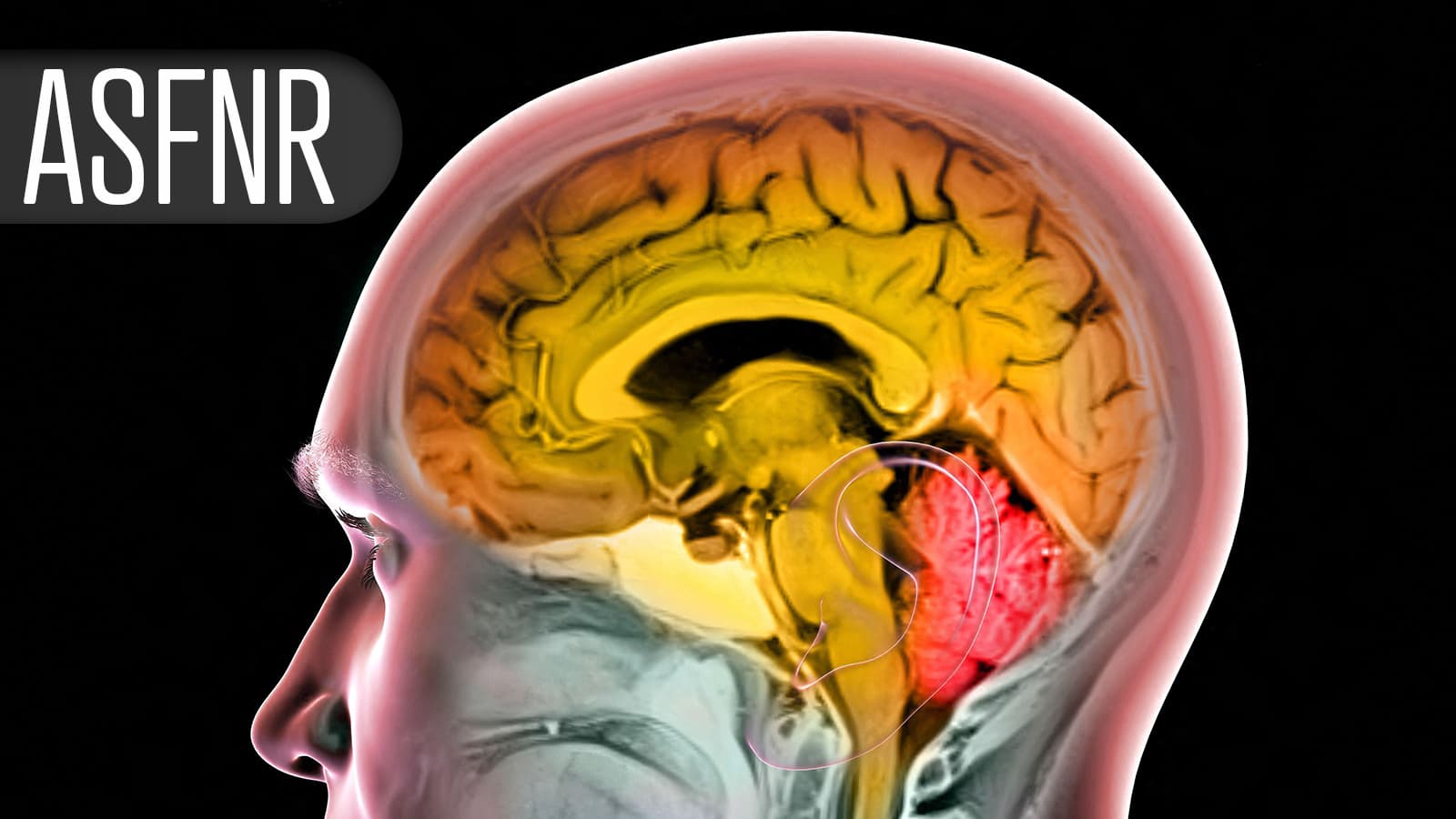 Microvascular Measure Gives Clues to Poor Response to Successful Thrombectomy
