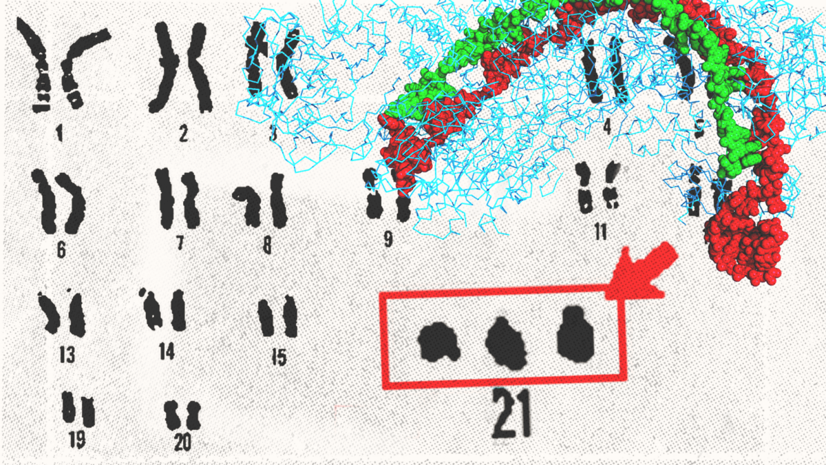 CRISPR Genome Editing and the Future of Down Syndrome Treatment
