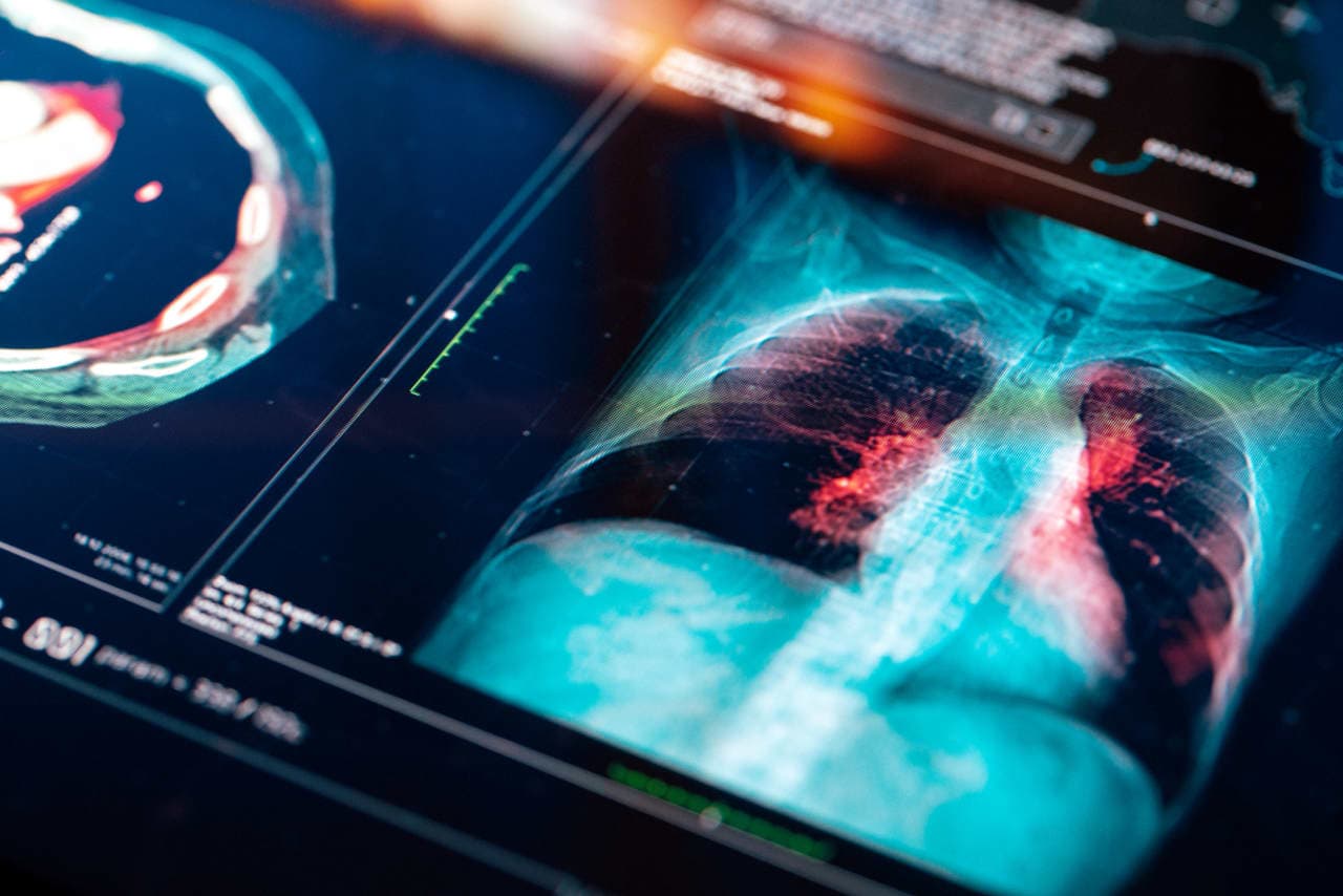 ‘King Keytruda’s reign continues.’ Investors aren’t wowed by a promising new lung cancer drug.