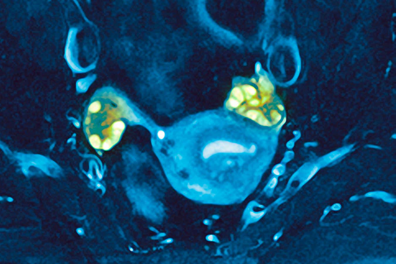PCOS postpones perimenopause and allows pregnancies at older ages