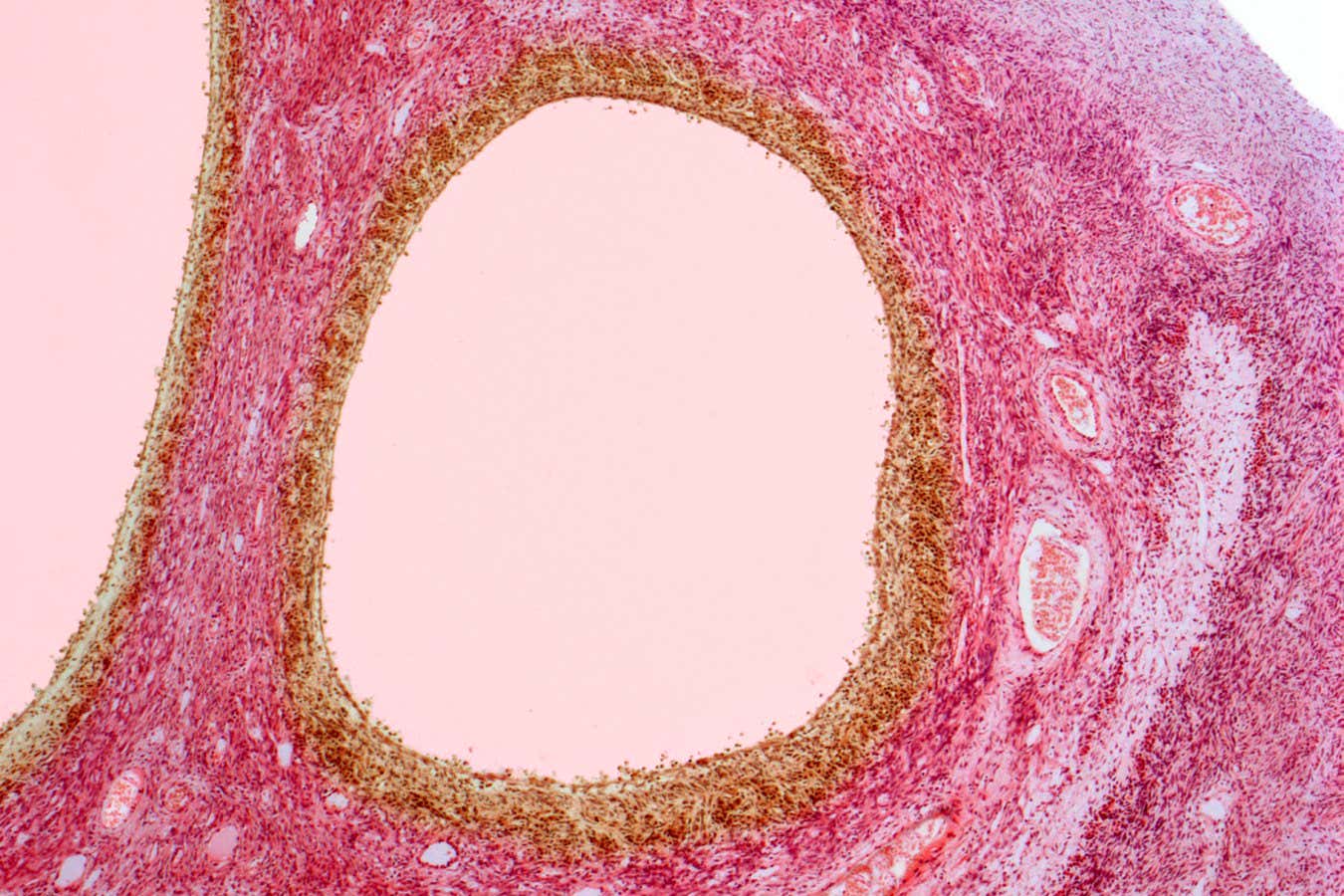 PCOS has been officially renamed PMOS, and it’s a momentous move