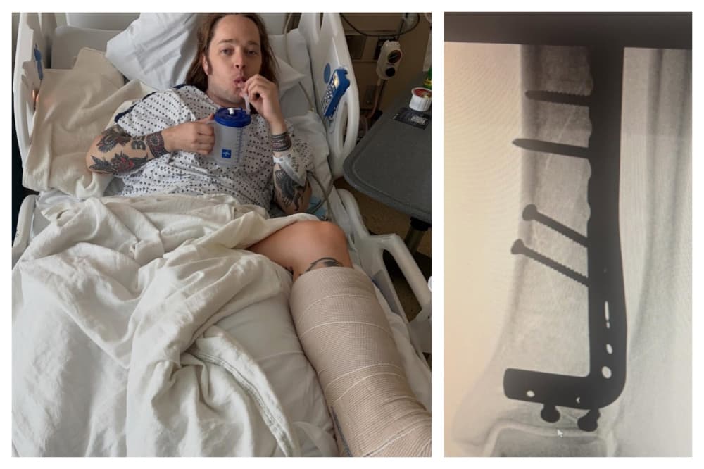 Billy Strings Breaks Leg in Two Places While Skateboarding During Encore Break: ‘I Heard It Snap Over the Screaming Crowd!’