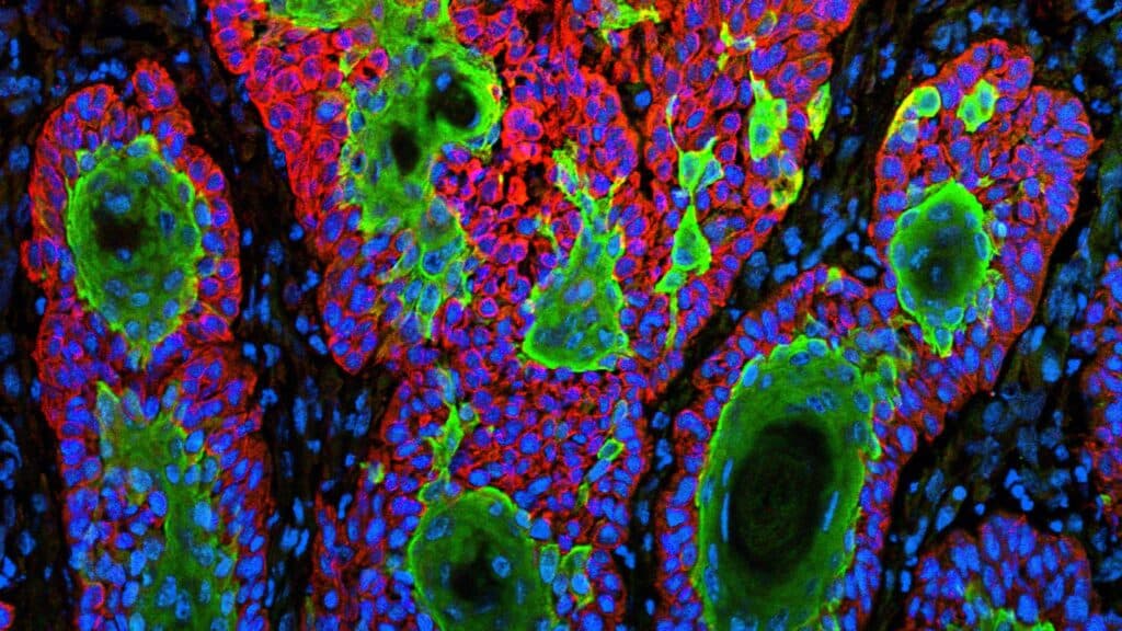 STAT+: Replimune skin cancer drug that became FDA flashpoint is rejected again