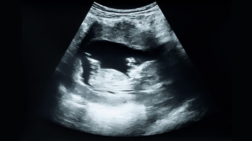 C-section rate in 2025 highest in a decade 