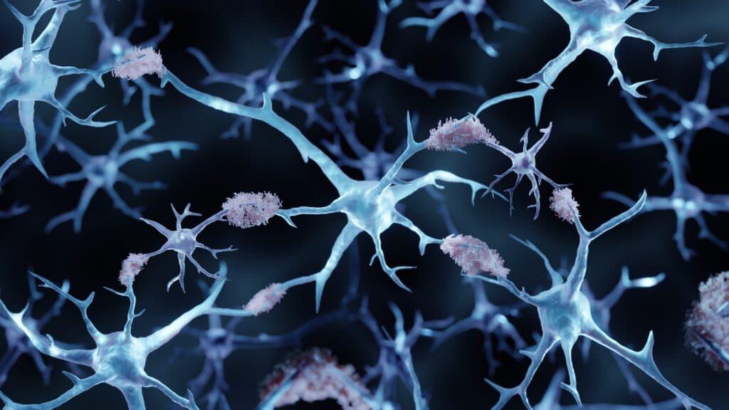 STAT+: Cochrane review reignites Alzheimer’s amyloid wars