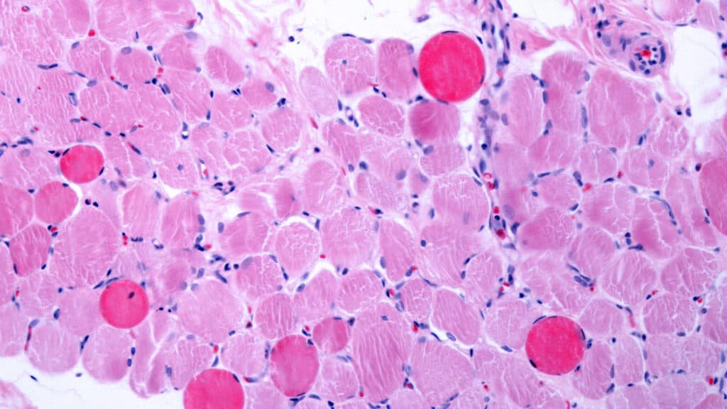 STAT+: Next-gen Duchenne drug from Entrada disappoints