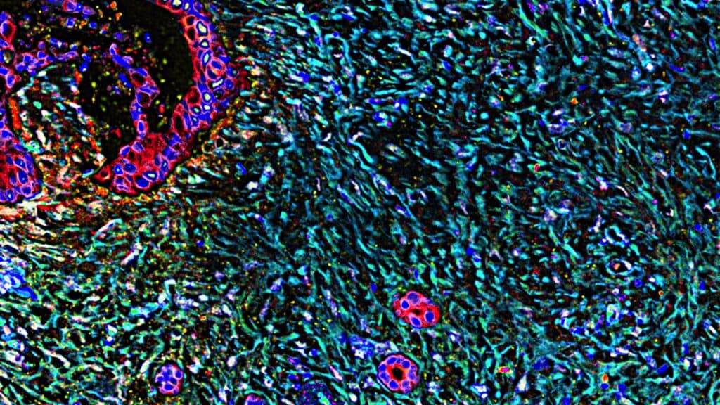 STAT+: A pancreatic cancer expert on why Revolution Medicines’ study could ‘open up a new era’ of treatment